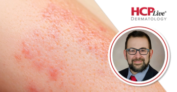 Tilrekimig Meets EASI-75 Goal in Atopic Dermatitis, With Eric Simpson, MD