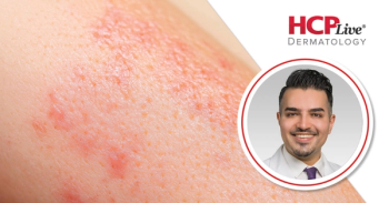 Addressing Discoid Lupus in Skin of Color: Clinical and Social Challenges