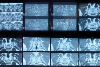 Secukinumab Approved for Active Non-radiographic Axial Spondyloarthritis