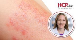 Non-Steroidal Topicals: A Game-Changer for Pediatric Atopic Dermatitis, With Emily Becker, MD