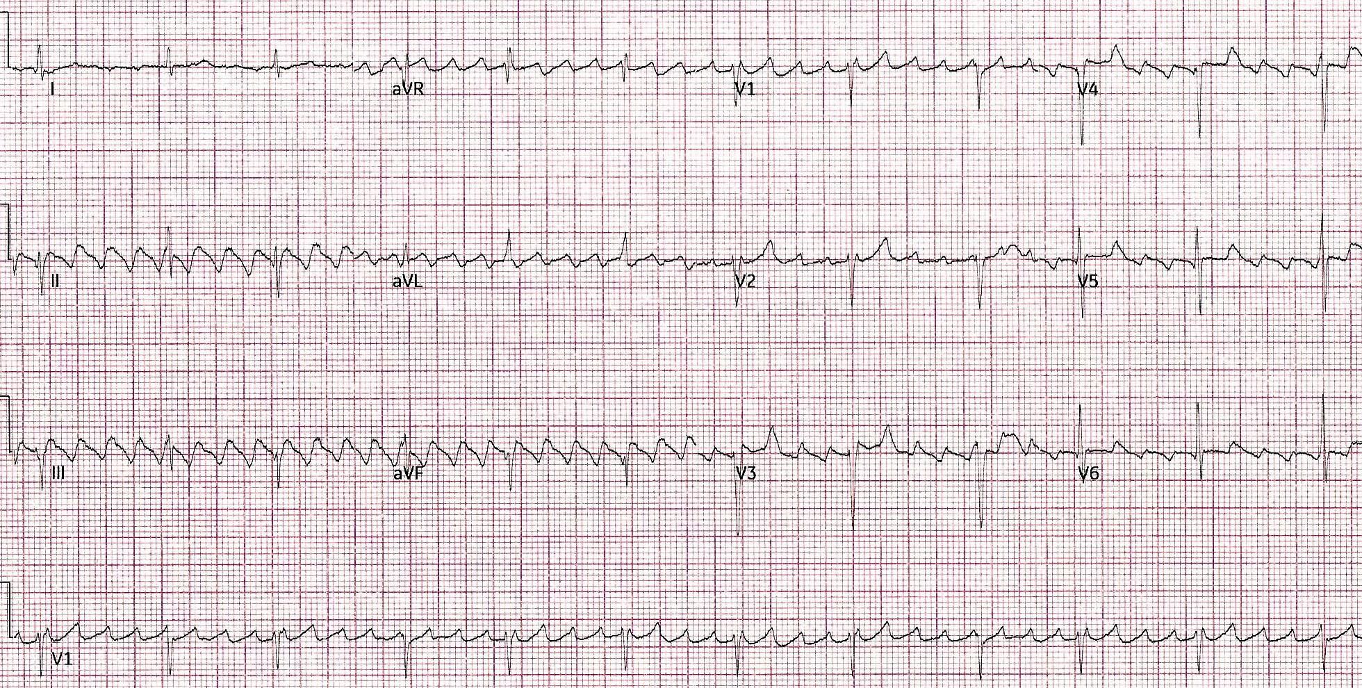 ECG printout from a patient featured in a case report | Credit: Brady Pregerson, MD