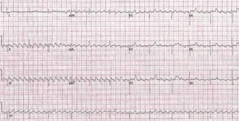 ECG printout from a patient featured in a case report | Credit: Brady Pregerson, MD