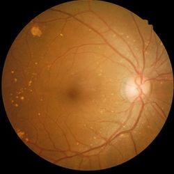 Occurence of Retinal Vein Occlusion Associated with Nonideal CV Health Score