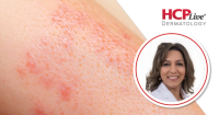 Q&A: What Are the Most Exciting New Atopic Dermatitis Developments? With Mona Shahriari, MD