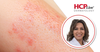 What is the Most Contested Issue in Atopic Dermatitis Today? With Mona Shahriari, MD