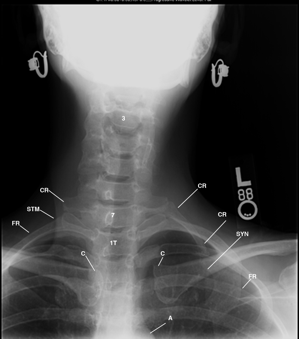 Missed Cervical Ribs Alter Pain Management in Thoracic Outlet Syndrome