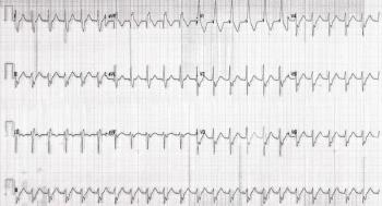 Computer Read: Sinus tach at 132, Non-specific intraventricular conduction delay.  Credit: Brady Pregerson, MD