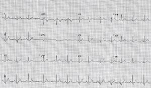 Case Report: Fatigue Following a Diverticular Bleed
