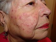 Facial Rash in an Elderly Woman