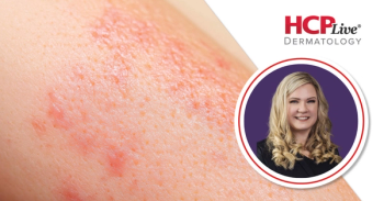 Discussing Granuloma Annulare, Lichenoid Disorders, and Social Media, With Shannon Trotter, DO
