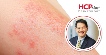 Povorcitinib Improves Itch, Hive CSU Symptoms Within 3 Days, With Weilly Soong, MD