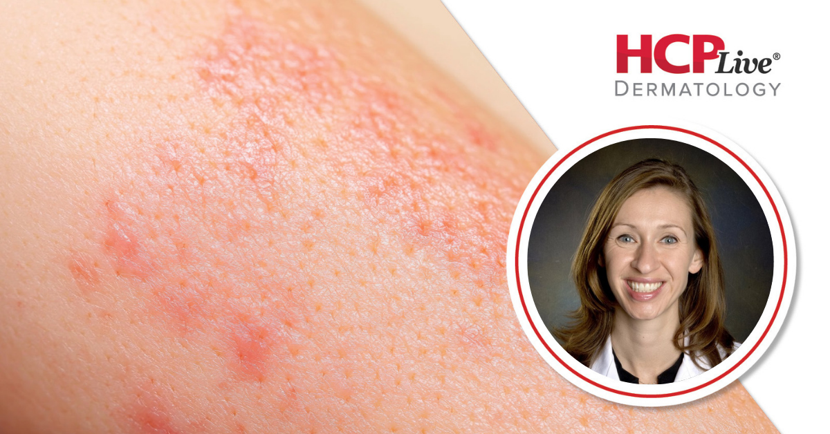 Q&A: Zumilokibart Effective for Atopic Dermatitis, With Ruth Ann Vleugels, MD, MPH, MBA