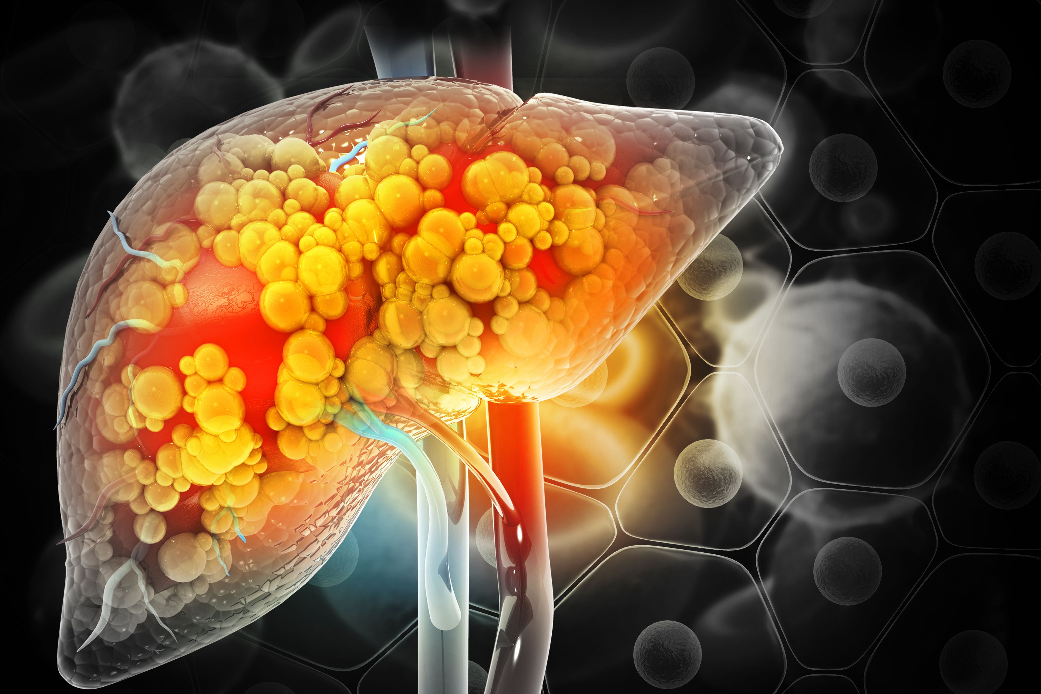 Liver fibrosis illustration. | Credit: Adobe Stock