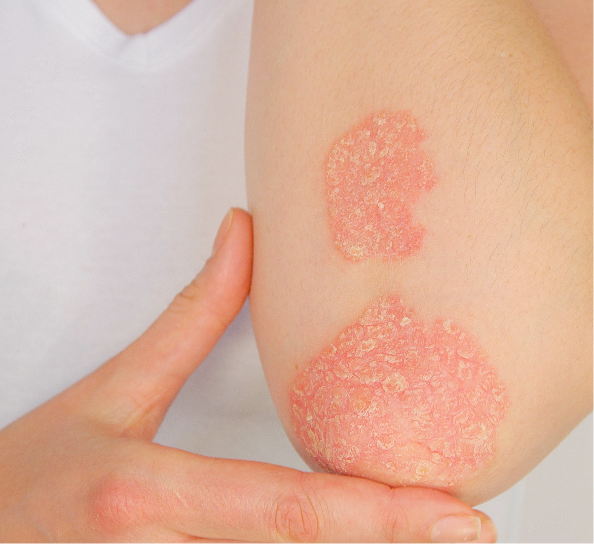 Concomitant methotrexate does not increase the efficacy of ustekinumab in patients with psoriatic arthritis