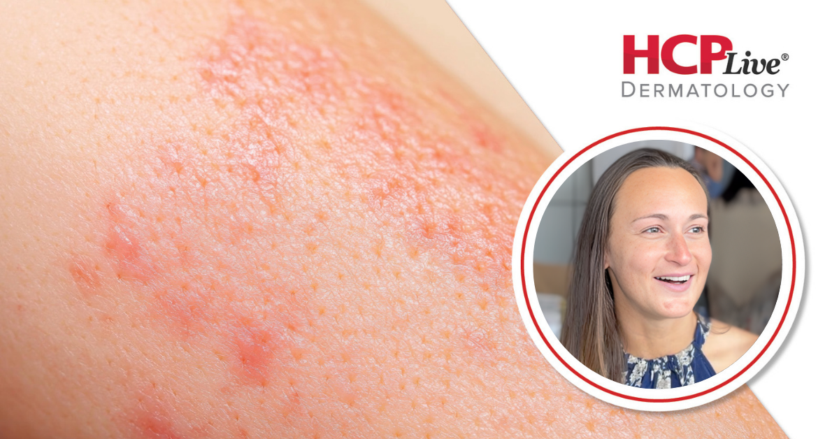 Patient Perspective on Topical Steroid Withdrawal, With Briana Banos