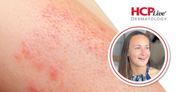 Patient Perspective on Topical Steroid Withdrawal, With Briana Banos