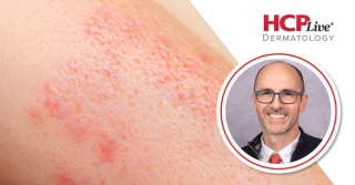Baricitinib Response Deepens Overtime in Alopecia Areata, With Brett King, MD, PhD