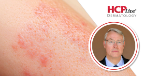 Pigmentation Pipeline: Vitiligo and Melasma Treatment Advances