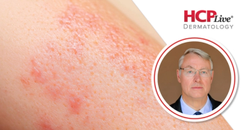 Pigmentation Pipeline: Vitiligo and Melasma Treatment Advances