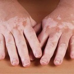 Oral Povorcitinib for Extensive Nonsegmental Vitiligo Yields Positive Results in Phase 2b Trial