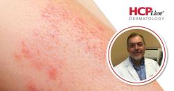 Rezpegaldesleukin Shows Strong Phase 2B Results for Atopic Dermatitis, Asthma