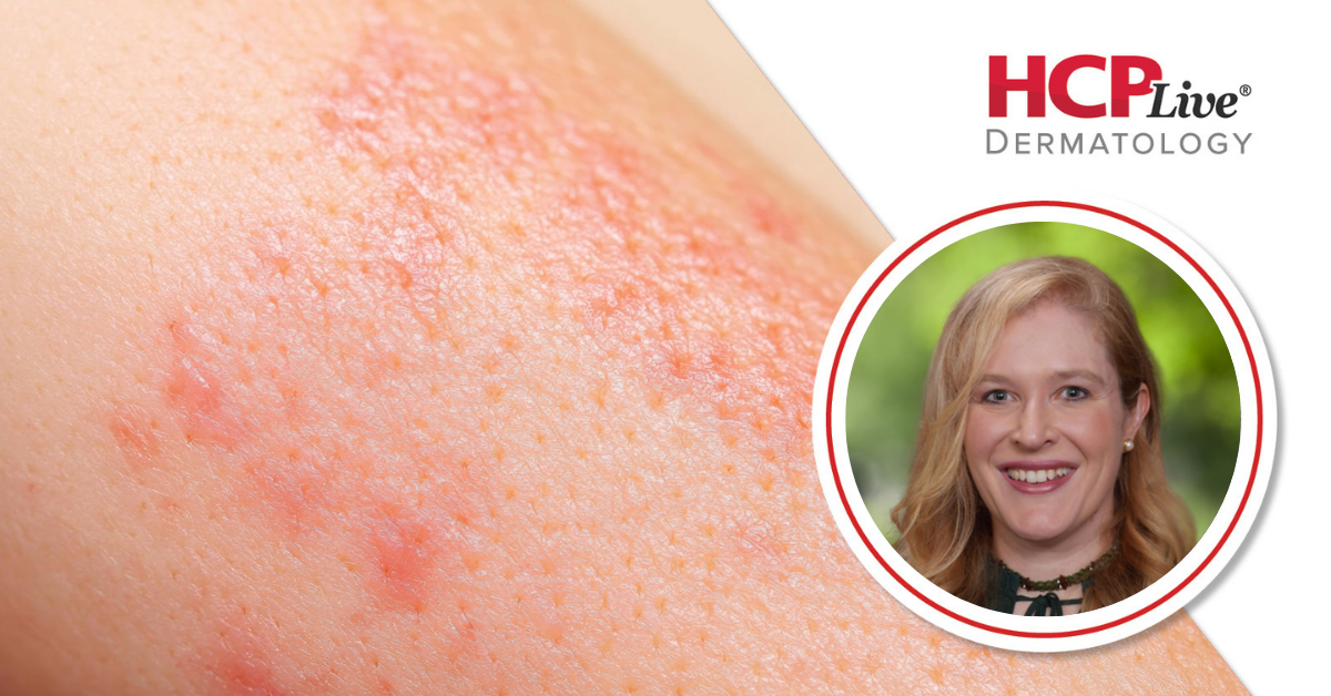 How to Safely Treat Acne, Psoriasis, and Eczema During Pregnancy