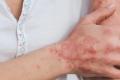 Plaque Psoriasis Treated With Tildrakizumab Shown to be Effective in Real-World Settings