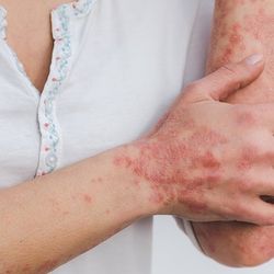 Psoriasis Patients with Lupus Erythematosus Skew Female, More Likely to Have Joint Involvement