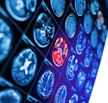 GLP-1 RAs More Effective Than Metformin for Reducing Dementia Risk in T2DM