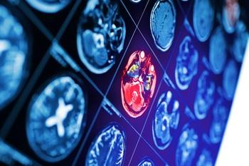 GLP-1 RAs More Effective Than Metformin for Reducing Dementia Risk in T2DM