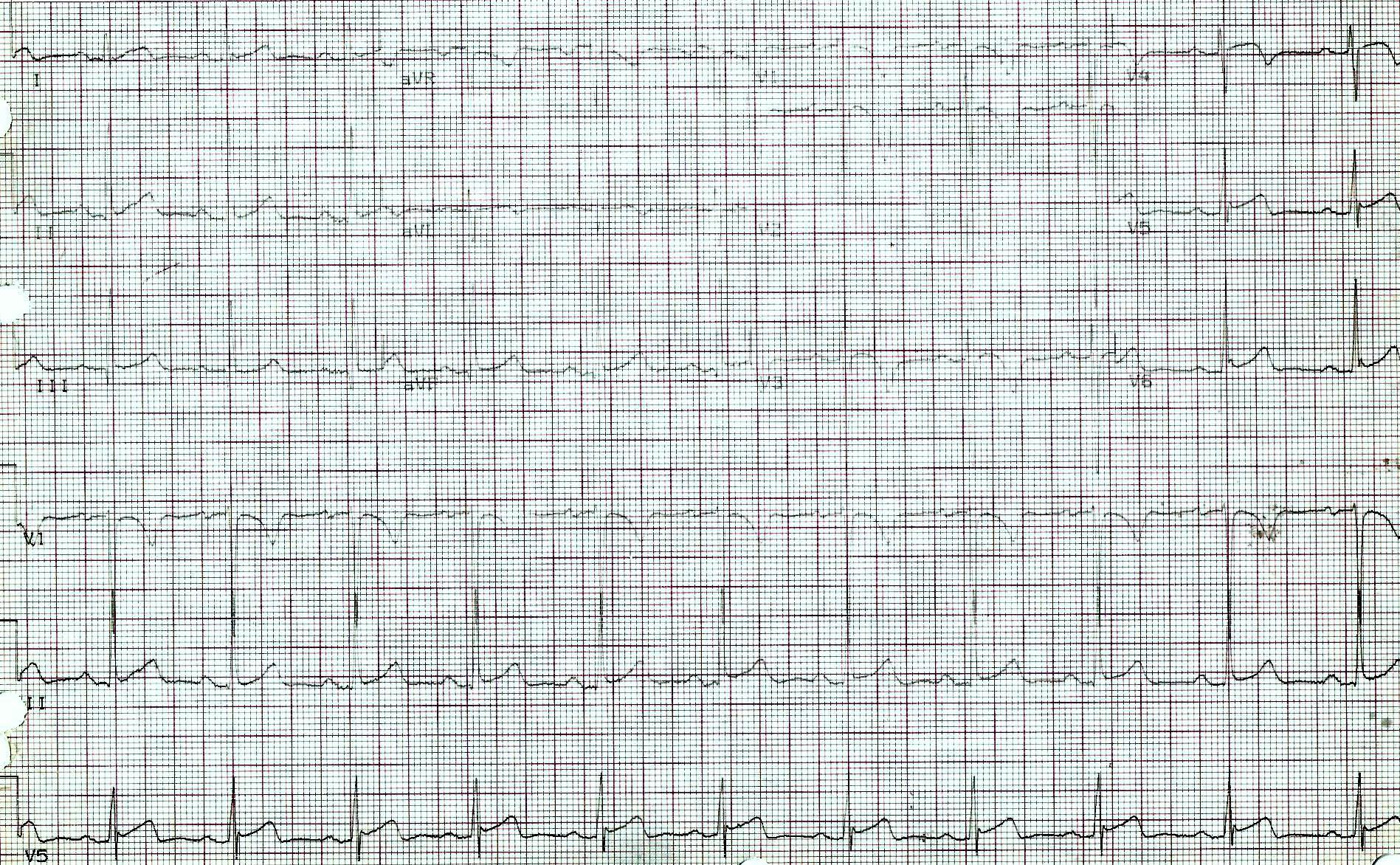 ECG printout