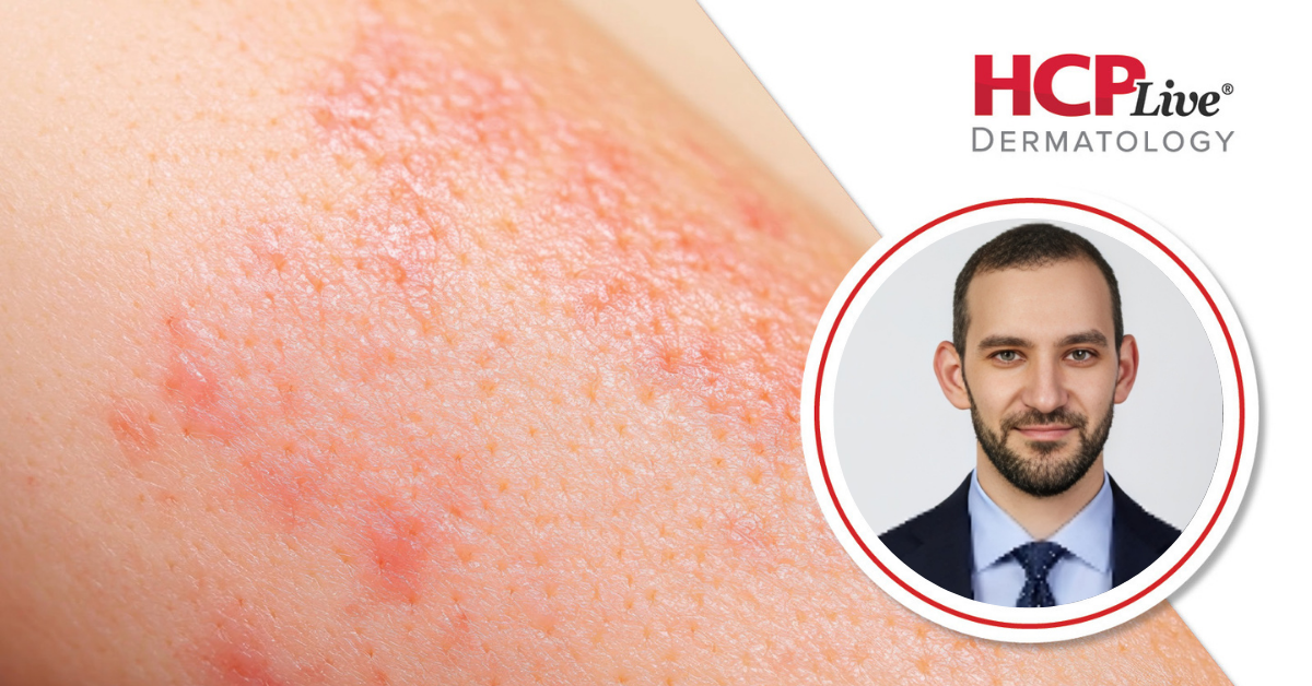 Early Signs of Scarring Alopecia, Pipeline Outlook, With Bejamin Ungar, MD