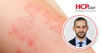 JAK Inhibitors, Oral Minoxidil Reshape Hair Loss Care