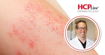 Discussing Remibrutinib Following FDA Approval for CSU, With Adam Friedman, MD