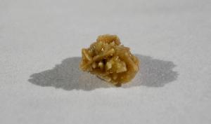 Obesity and Hyperlipidemia Associated with Uric Acid Kidney Stones