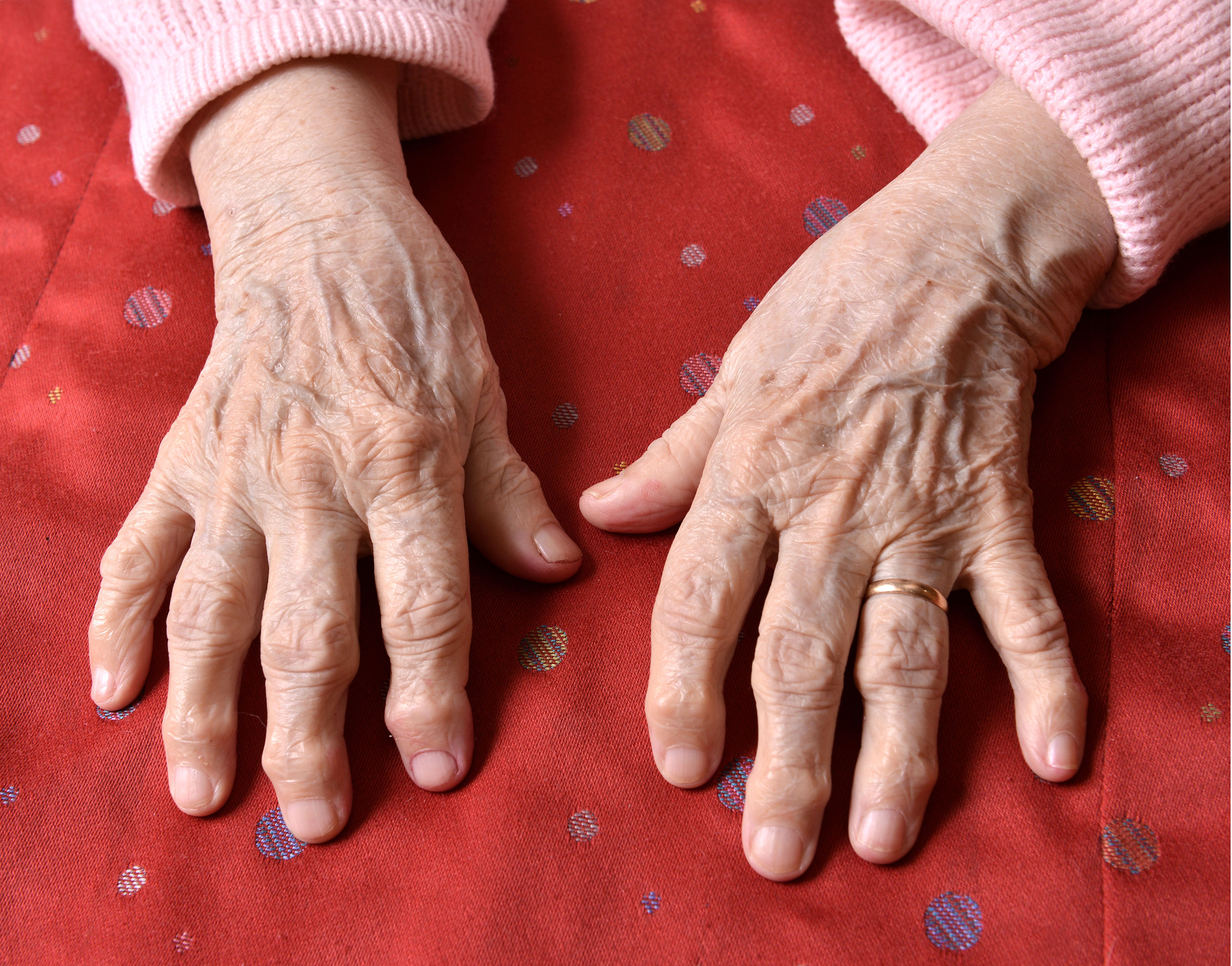 Baricitinib Versatile and Effective in Rheumatoid Arthritis