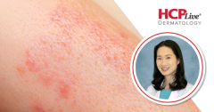 Biologic Selection and Comorbidity Screening in HS, With Jennifer Hsiao, MD