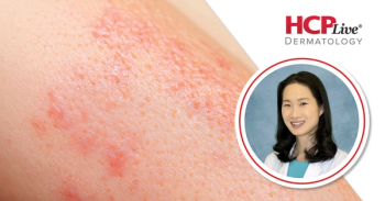 Q&A: Comorbidity Screening and Biologic Timing in HS, With Jennifer Hsiao, MD