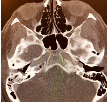 CT image of a patient with diabetes mellitus and gradually worsening ear pain.