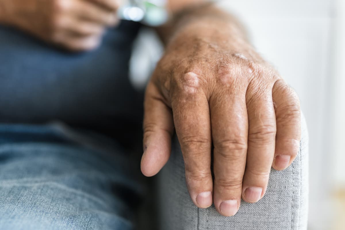 Methotrexate, Apremilast Show Similar Efficiency Outcomes in Head-to-Head PsA Study - Vimarsana News