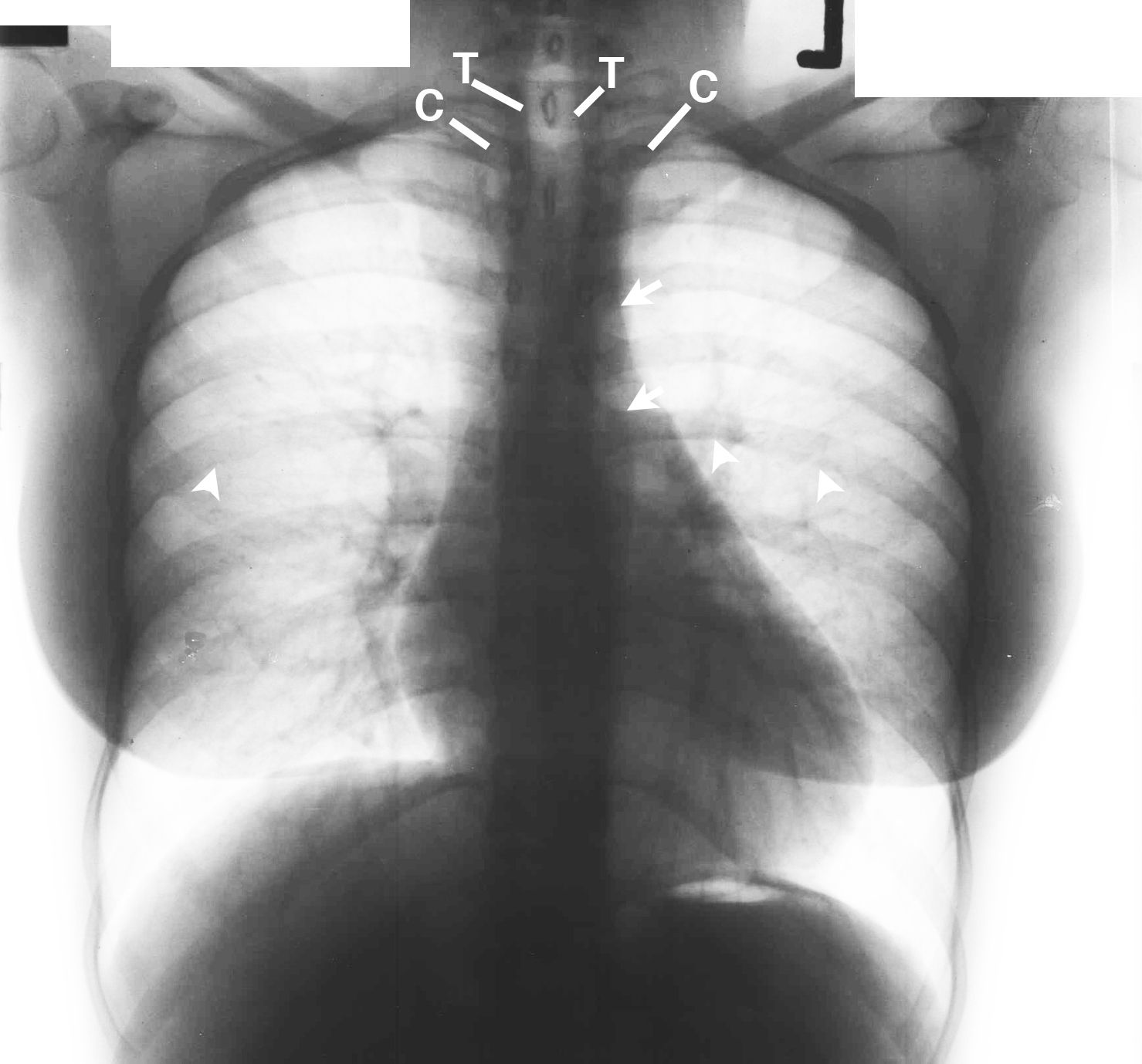 Superior Rib Notching Why Does This Young Woman with Hypertension Have Rib Notching on Her ...