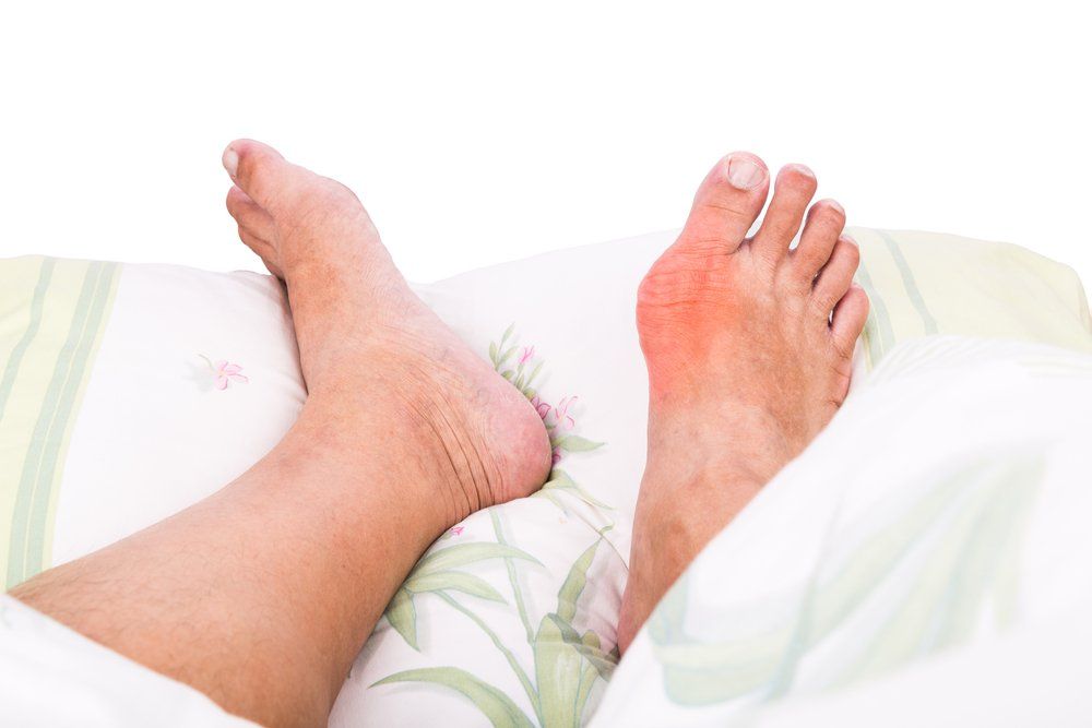 Gout man feet toes bed obese obesity