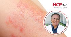 Denifanstat Sustains Acne Control Through 52 Weeks, With Neal Bhatia, MD