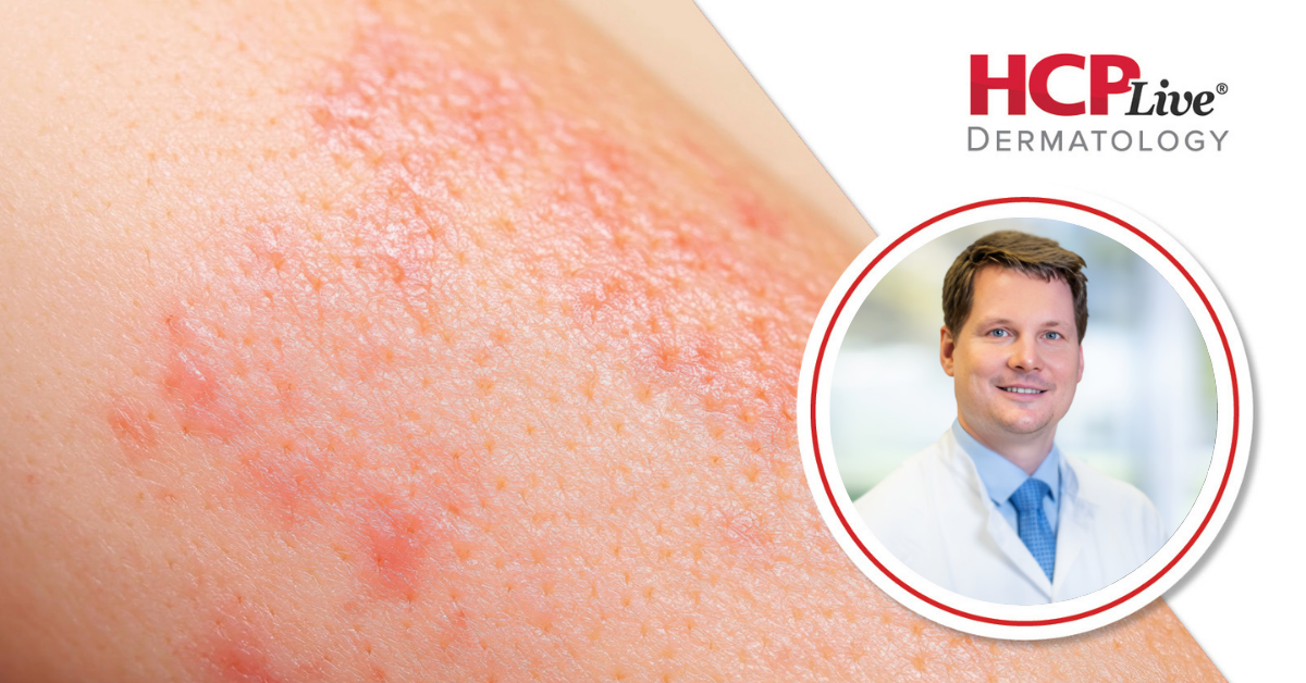 Significance of New Phase 3 Lebrikizumab Trial in Nummular Eczema, With Kilian Eyerich, MD, PhD