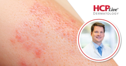 Phase 3 LumiNE Trial to Assess Lebrikizumab in Nummular Eczema, With Kilian Eyerich, MD, PhD