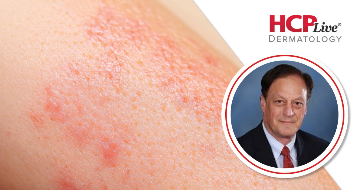 Long-Term Safety of Roflumilast Cream for Children, With Lawrence Eichenfield, MD