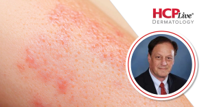 Long-Term Safety of Roflumilast Cream for Children, With Lawrence Eichenfield, MD