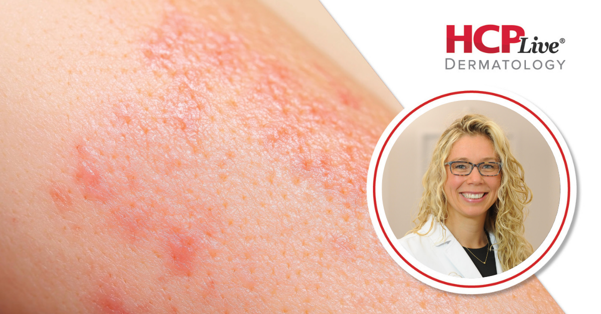 How to Get Involved in Community Service in Dermatology, With Elizabeth Kiracofe, MD