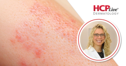 Getting Involved in the Community as a Dermatologist, With Elizabeth Kiracofe, MD