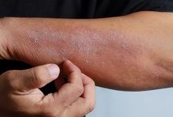 Contact Dermatitis to Common Wound Care Products Exacerbates Chronic Ulcers